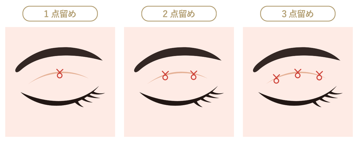 二重埋没法