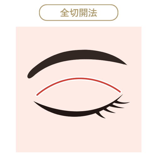 全切開法 全切開法