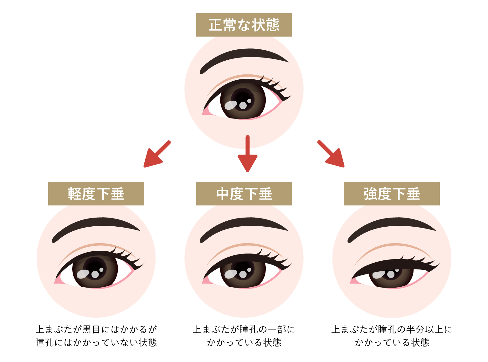 眼瞼下垂術 眼瞼下垂術