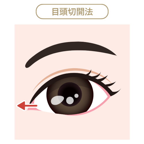 目頭切開法 眼目頭切開法
