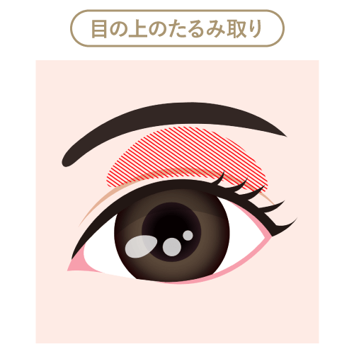 目の上のたるみ取り 目の上のたるみ取り