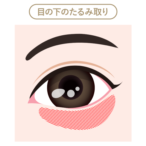 目の下のたるみ取り 目の下のたるみ取り