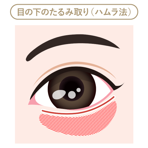 目の下のたるみ取り(ハムラ法) 目の下のたるみ取り(ハムラ法)