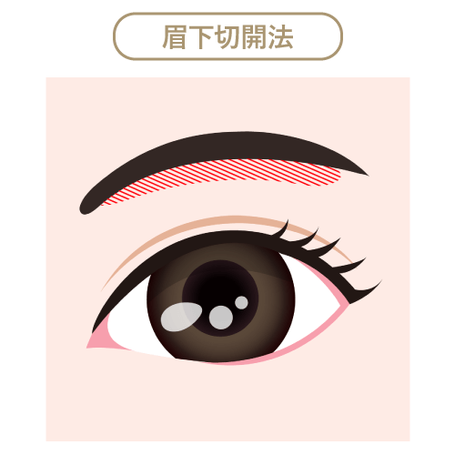 眉下切開法 眉下切開法