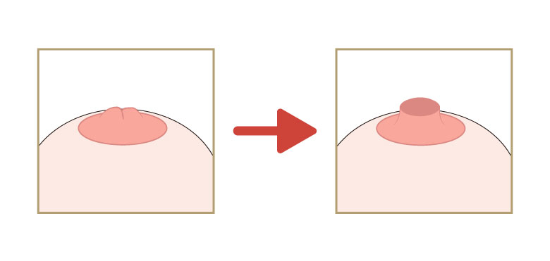 陥没乳頭