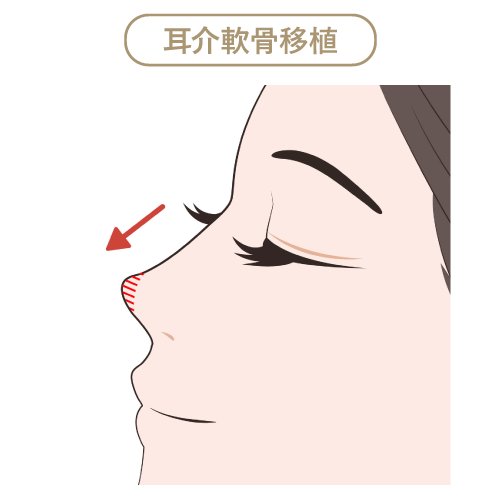 耳介軟骨移植 耳介軟骨移植