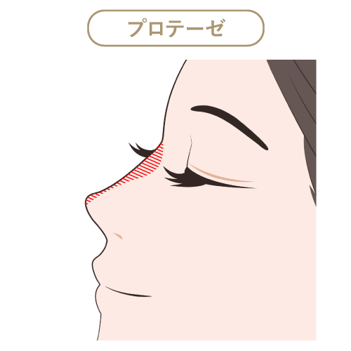 プロテーゼ プロテーゼ