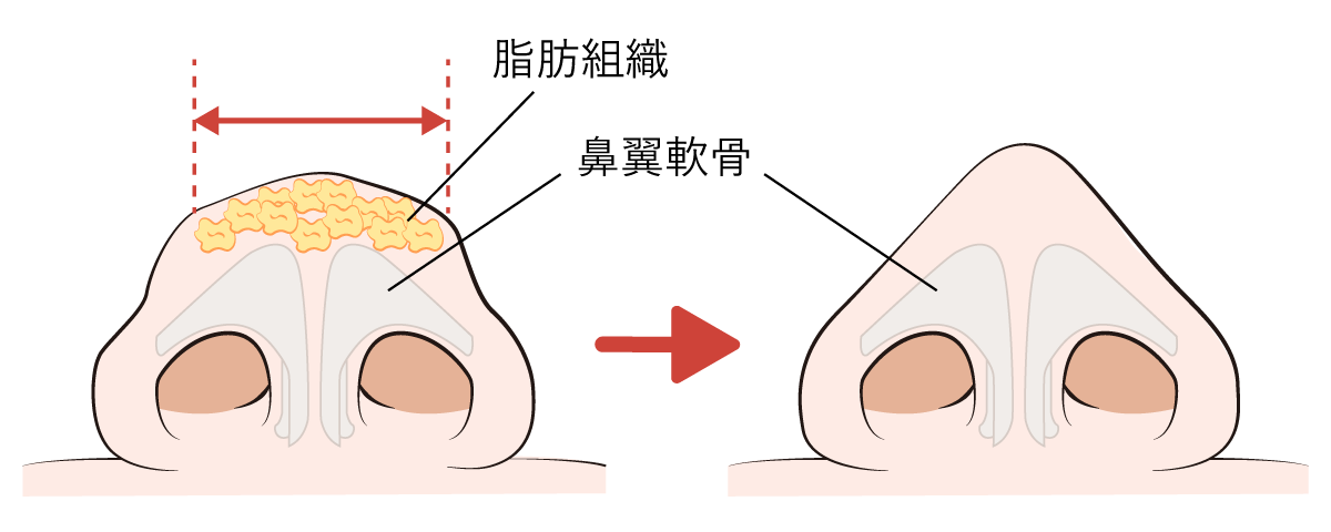 鼻尖形成 鼻尖形成